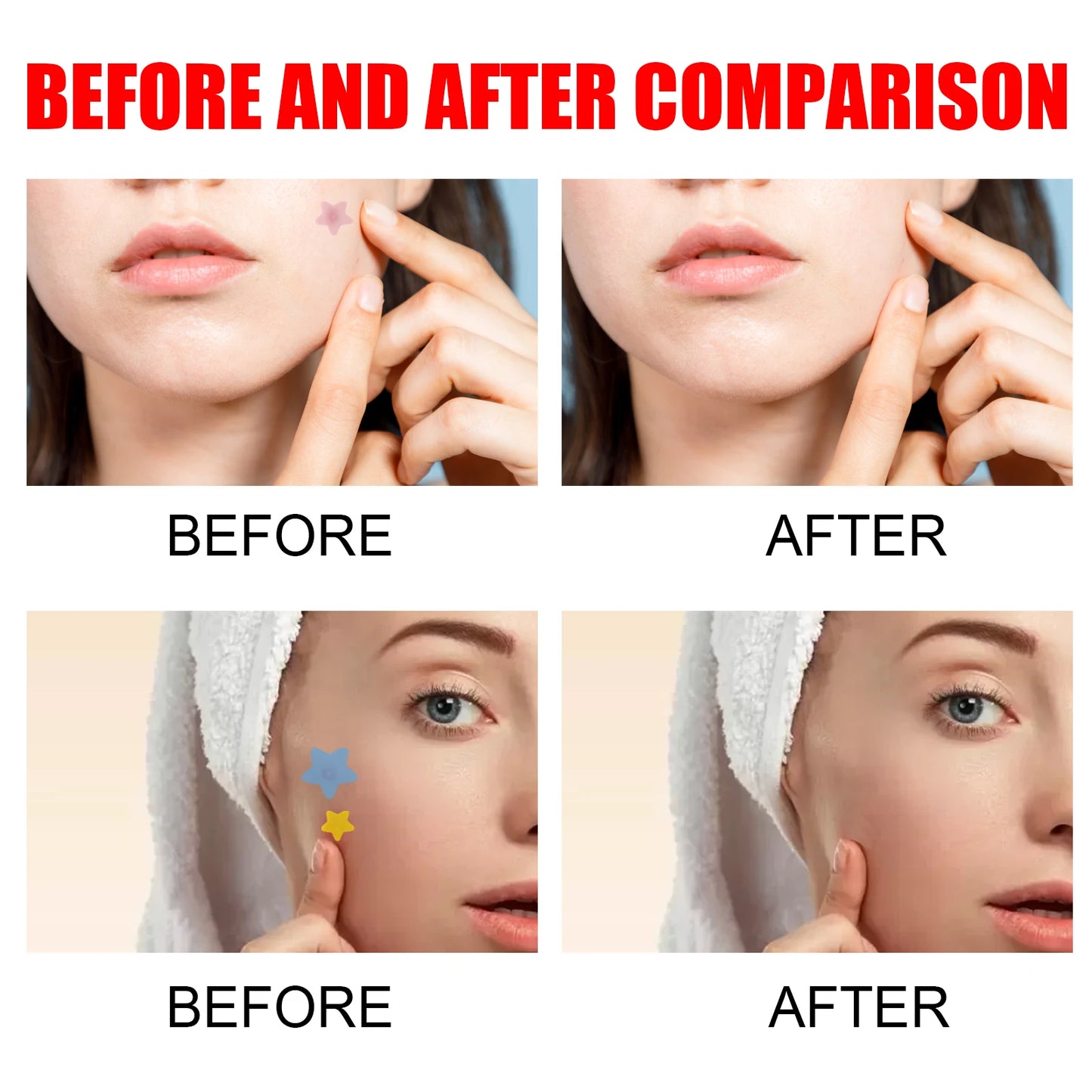 200pcs Repair Acne Patches Fade Acne Marks Red Seal Cover Blemishes Spots Remove Pimples Invisible Acne Removal Skincare Patches